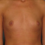Breast Augmentation Before & After Patient #2649