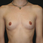 Breast Augmentation Before & After Patient #2655