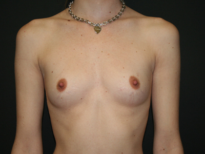 Breast Augmentation Before & After Patient #2655