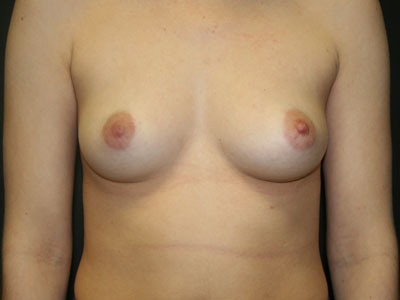 Breast Augmentation Before & After Patient #2662
