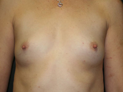 Breast Augmentation Before & After Patient #2688