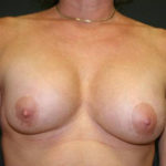 Breast Revision Before & After Patient #2690