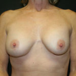 Breast Revision Before & After Patient #2706