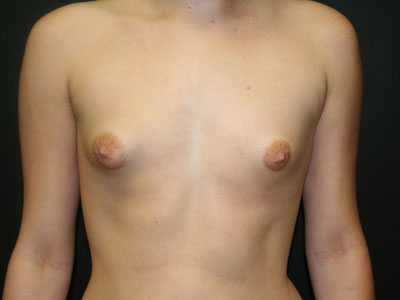 Breast Augmentation Before & After Patient #2716