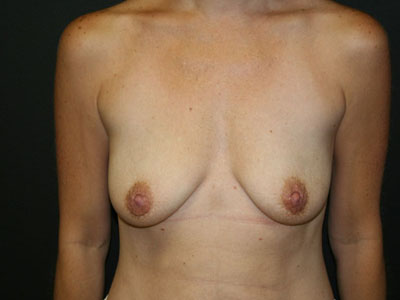 Breast Augmentation Before & After Patient #2720