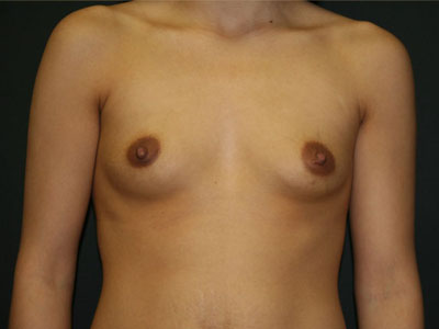 Breast Augmentation Before & After Patient #2726