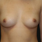 Breast Augmentation Before & After Patient #2733