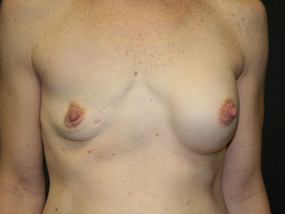 Breast Revision Before & After Patient #2745