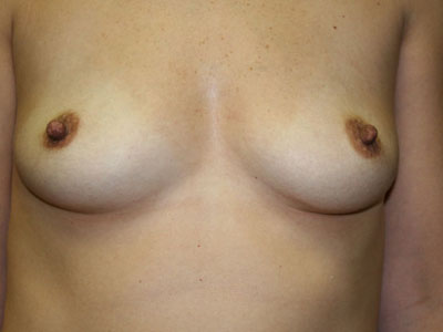 Breast Augmentation Before & After Patient #2765