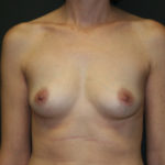 Breast Augmentation Before & After Patient #2770