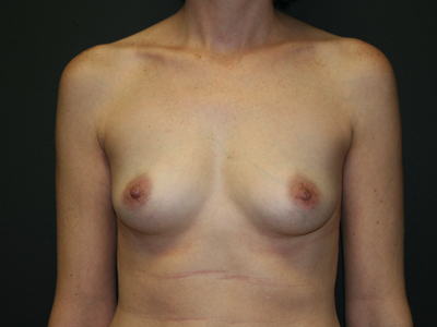 Breast Augmentation Before & After Patient #2770