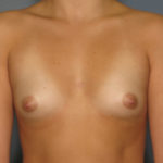 Breast Augmentation Before & After Patient #2781