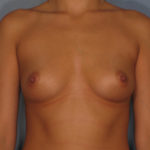 Breast Augmentation Before & After Patient #2800