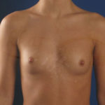 Breast Augmentation Before & After Patient #2815