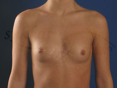 Breast Augmentation Before & After Patient #2815