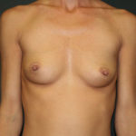 Breast Augmentation Before & After Patient #2829