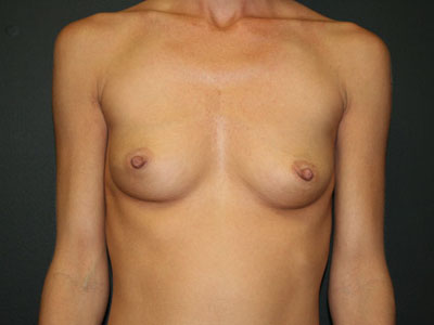 Breast Augmentation Before & After Patient #2829