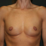 Breast Augmentation Before & After Patient #2855