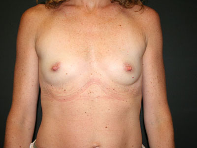Breast Augmentation Before & After Patient #2862