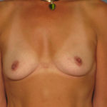 Breast Augmentation Before & After Patient #2867