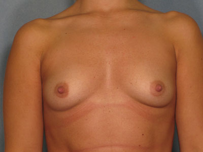 Breast Augmentation Before & After Patient #2872