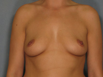 Breast Augmentation Before & After Patient #2884