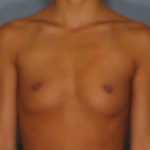 Breast Augmentation Before & After Patient #2894