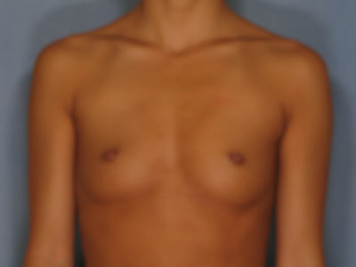 Breast Augmentation Before & After Patient #2894