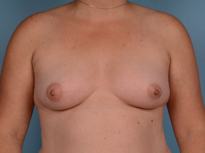 Breast Augmentation Before & After Patient #2925