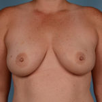 Breast Augmentation Before & After Patient #2930