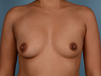 Breast Augmentation Before & After Patient #2994