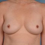 Breast Augmentation Before & After Patient #3001