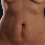 Tummy Tuck Before & After Patient #1475