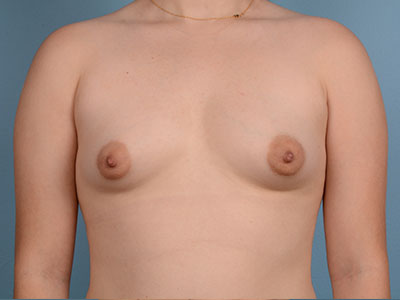 Breast Augmentation Before & After Patient #3030