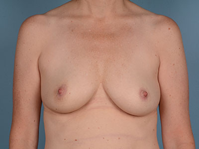 Breast Augmentation Before & After Patient #3037