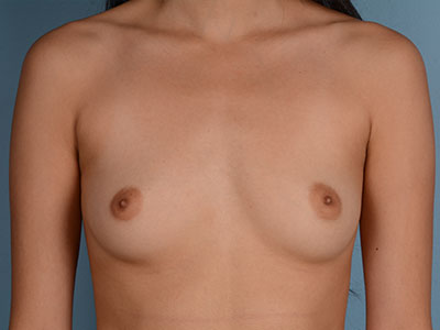 Breast Augmentation Before & After Patient #3067