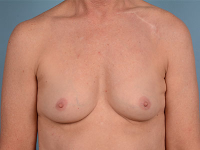 Breast Augmentation Before & After Patient #3075