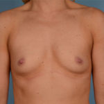 Breast Augmentation Before & After Patient #3092