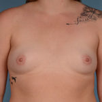 Breast Augmentation Before & After Patient #3100