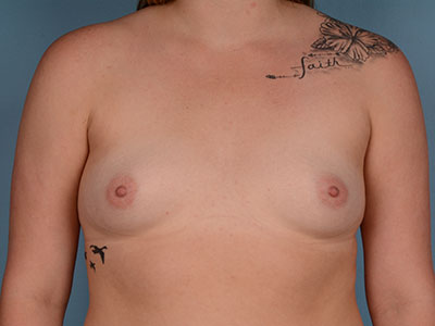 Breast Augmentation Before & After Patient #3100