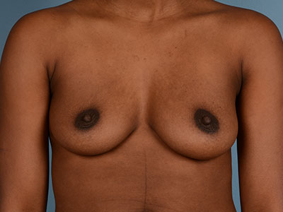 Breast Augmentation Before & After Patient #3115