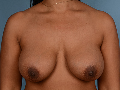 Breast Lift with Augmentation Before & After Patient #3160