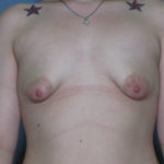 Breast Augmentation Before & After Patient #3211
