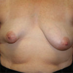 Congenital Breast Deformity Before & After Patient #3240