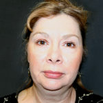 Face & Neck Lift Before & After Patient #4152