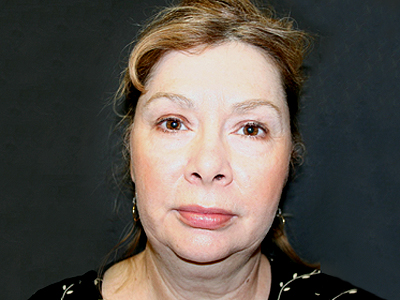 Face & Neck Lift Before & After Patient #4152