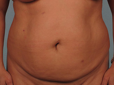 Tummy Tuck Before & After Patient #1281