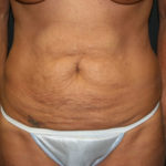 Tummy Tuck Before & After Patient #1547