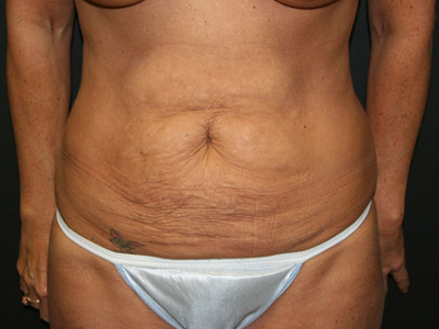 Tummy Tuck Before & After Patient #1547