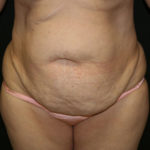 Tummy Tuck Before & After Patient #1586